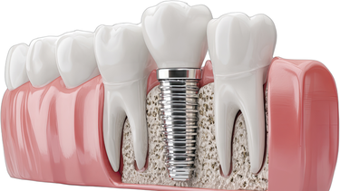 Cắm implant kiêng ăn gì? Chế độ dinh dưỡng giúp trụ tích hợp xương nhanh chóng 