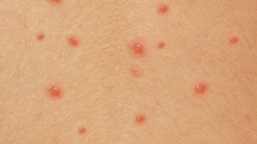 U mềm lây có tự khỏi không? Nguyên nhân, điều trị và phòng ngừa