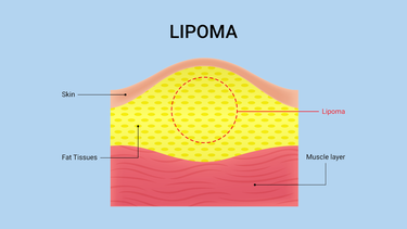 U mỡ có nguy hiểm không? Dấu hiệu nhận biết và hướng điều trị an toàn