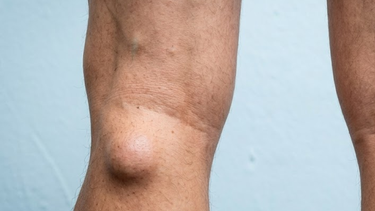 U nang bao hoạt dịch khớp gối: Biểu hiện, nguyên nhân và điều trị