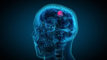 U não có di truyền không? Cách nhận biết nguy cơ