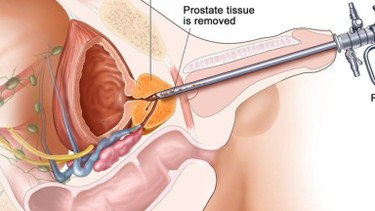 U xơ tiền liệt tuyến có nên mổ không? Các trường hợp cần phẫu thuật và phương pháp điều trị