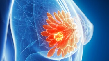 U xơ tuyến vú có nguy hiểm không? Chẩn đoán và hướng điều trị