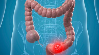 Ung thư trực tràng có nguy hiểm không? Những điều bạn cần biết