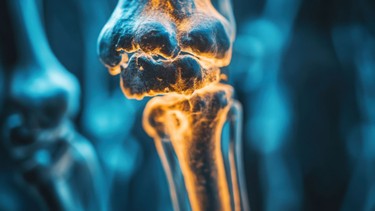 Ung thư xương sống được bao lâu? Yếu tố ảnh hưởng đến thời gian sống của người bệnh