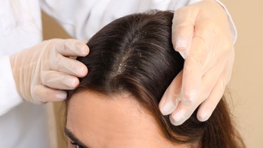 Vảy nến da đầu: Bệnh da liễu dai dẳng và cách điều trị hiệu quả