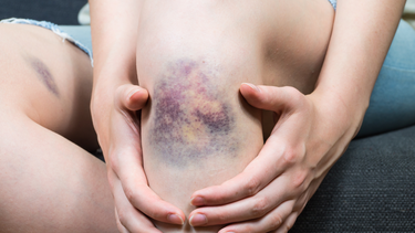 Vết bầm tím bao lâu thì hết? Nguyên nhân và cách làm mờ nhanh hơn