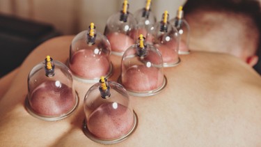 Vết bầm tím khi giác hơi: Nguyên nhân và cách chăm sóc đúng cách