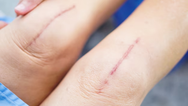 Vết mổ bị sưng cứng bên trong có nguy hiểm không?