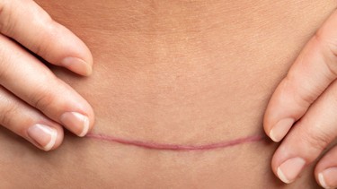 Vết mổ sau sinh bị đỏ: Dấu hiệu bình thường hay cảnh báo biến chứng nguy hiểm?