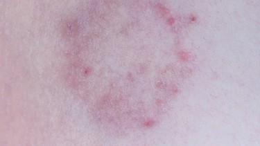 Vết tròn bị nổi đốm đỏ trên da không ngứa: Cảnh báo nguyên nhân ít người để ý