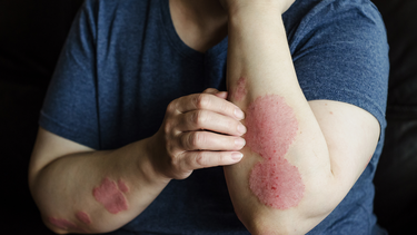 Nguyên nhân xuất hiện vết tròn bị nổi đốm đỏ trên da và ngứa​