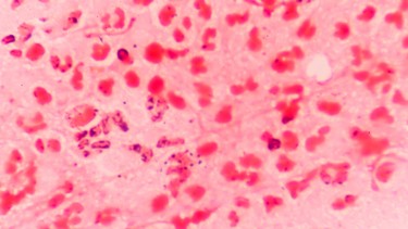 Vi khuẩn lậu là gì? Những thông tin cần biết để bảo vệ sức khỏe