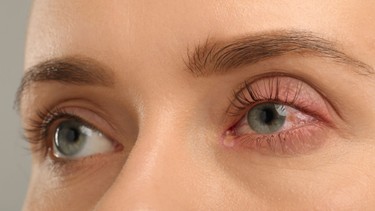 Viêm bờ mi mắt có lây không? Cách phòng ngừa hiệu quả