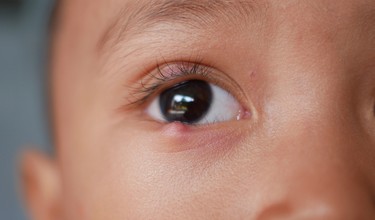 Viêm bờ mi dưới là gì? Biến chứng khi điều trị không đúng cách