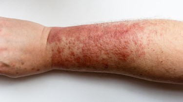 Viêm da liên cầu: Nguyên nhân, triệu chứng và cách điều trị