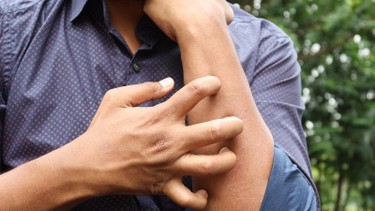 Viêm da tiếp xúc dị ứng là gì? Nguyên nhân, triệu chứng, điều trị