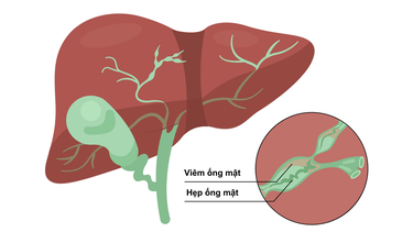 Viêm đường mật: Nguyên nhân, triệu chứng và điều trị
