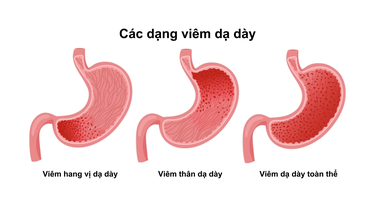 Viêm hang vị dạ dày: Nguyên nhân, triệu chứng và điều trị