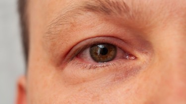 Viêm kết giác mạc cấp: Nhận biết sớm để bảo vệ thị lực