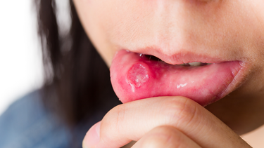 Viêm khoang miệng là gì? Nguyên nhân, triệu chứng và cách điều trị