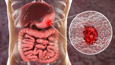 Viêm loét dạ dày tá tràng có khỏi được không?