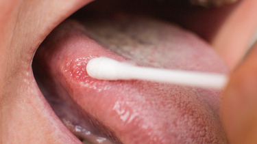 Viêm lưỡi: Triệu chứng, nguyên nhân, cách điều trị và phòng ngừa