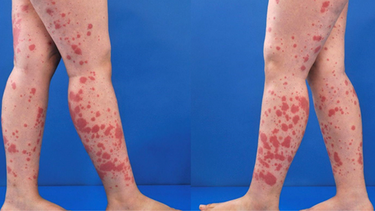 Viêm mao mạch dị ứng bao lâu thì khỏi? Điều trị bệnh như thế nào?