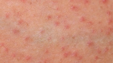 Viêm nang lông do nấm Malassezia: Dấu hiệu, nguyên nhân và cách điều trị