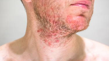 Viêm nang lông ở mặt​: Dấu hiệu và cách phòng ngừa