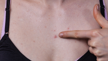 Viêm nang lông ở ngực​ khi nào khỏi? Tình trạng này có lây không?