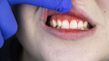 Viêm nướu: Những điều bạn cần biết để bảo vệ sức khỏe răng miệng