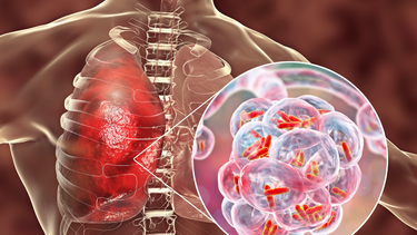 Viêm phổi do Klebsiella pneumoniae có nguy hiểm không?