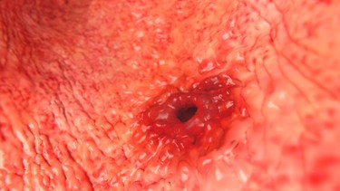 Viêm trợt hang vị dạ dày nên ăn gì? Những lưu ý trong ăn uống