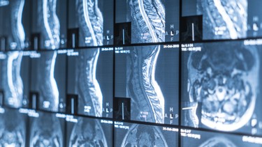 Viêm tủy xương: Triệu chứng và cách phòng ngừa