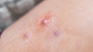 Viêm tuyến mồ hôi mủ là gì? Nguyên nhân và cách điều trị