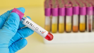 Virus EV71 tay chân miệng có độc lực cao đã trở lại