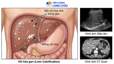 Vôi hoá gan là gì? Nguyên nhân, dấu hiệu và khi nào cần theo dõi sức khỏe gan
