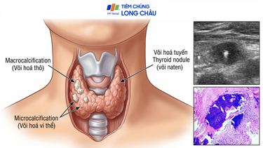 Vôi hoá tuyến giáp là gì? Dấu hiệu, nguyên nhân và khi nào cần đi khám