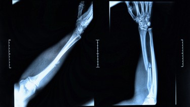 X-quang xương cẳng tay là gì? Khi nào cần thực hiện X-quang ở xương cẳng tay?