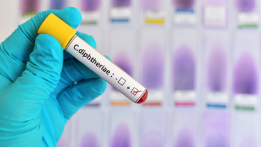 Xét nghiệm bạch hầu: Khi nào cần làm và quy trình thực hiện