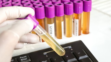 Xét nghiệm cặn Addis là gì? Vai trò của xét nghiệm cặn Addis trong quản lý bệnh thận