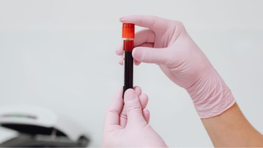 Xét nghiệm CRP và CRP-hs khác nhau như thế nào?