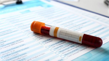 Xét nghiệm Fructosamine là gì? Khi nào cần thực hiện xét nghiệm?