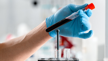 Xét nghiệm lipase là gì? Lipase thay đổi trong trường hợp nào?