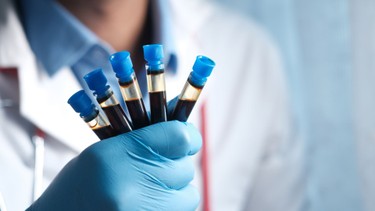 Xét nghiệm RPR là gì? Ý nghĩa của xét nghiệm RPR