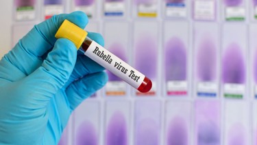 Xét nghiệm rubella cho bà bầu: Tại sao cần thiết và nên thực hiện khi nào?