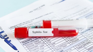Xét nghiệm Syphilis là gì? Các loại xét nghiệm Syphilis và quy trình thực hiện