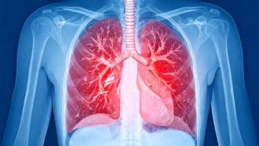 Xơ phổi sống được bao lâu và tiên lượng bệnh thế nào?
