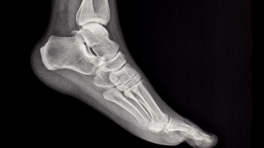 X-quang xương bàn chân: Ý nghĩa, quy trình thực hiện và những điều cần biết